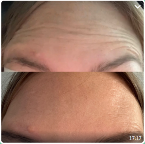 botulax before and after