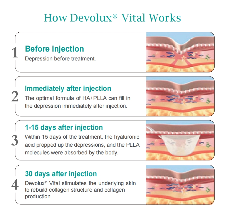 Devolux Plla Vial Cost
