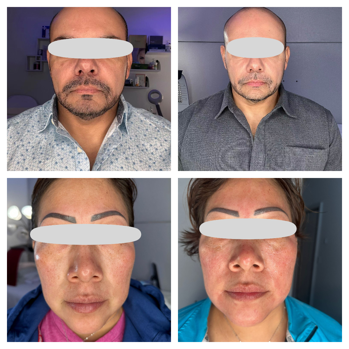 Prejuva 64mg Hyluaronic Acid Filler