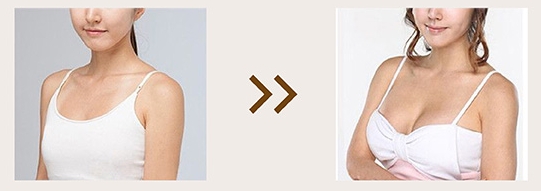 Before and After of Macrolite Breast Filler Injections (2)