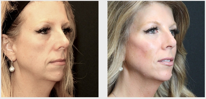 CHArmacy CaHA Filler before and after