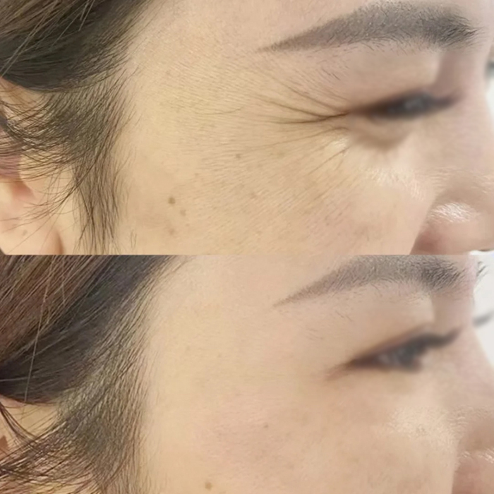 How Much Does Botulinum Toxin Cost: Exploring Botulinum Toxin Prices