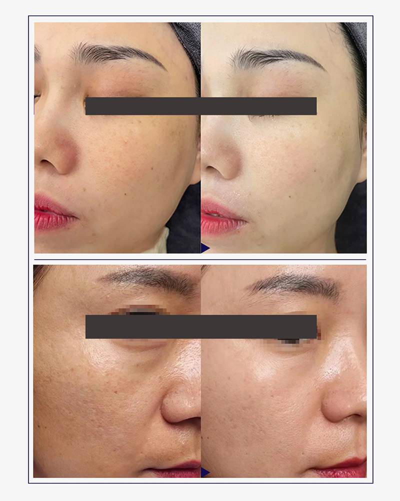 Mesocel Type Ⅲ Collagen Injection Before And After
