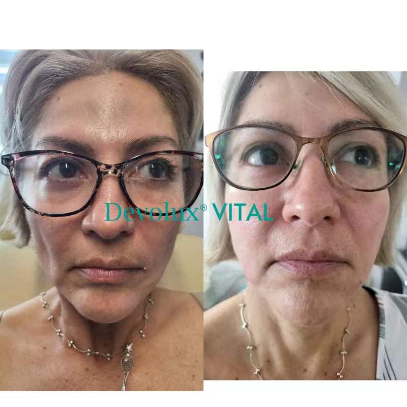 Devolux&reg; Vital PLLA Filler before and after