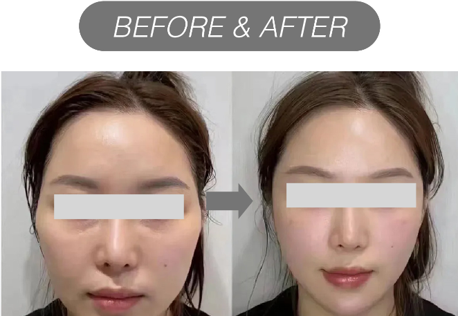 Mesotherapy