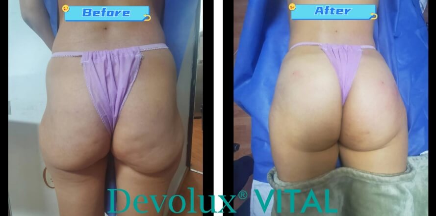 Devolux Plus Plla filler butt filler before and after