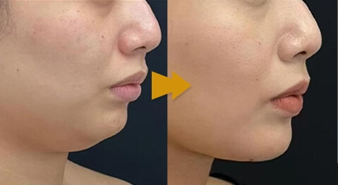 Fat Dissolving Injections Before and After Face