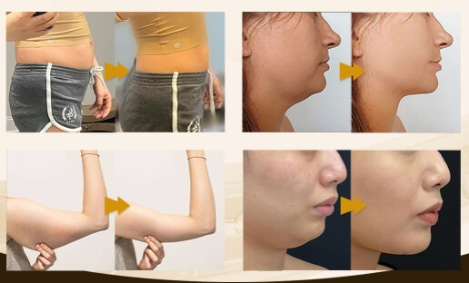 Lipogo Lipolytic Injections before and after