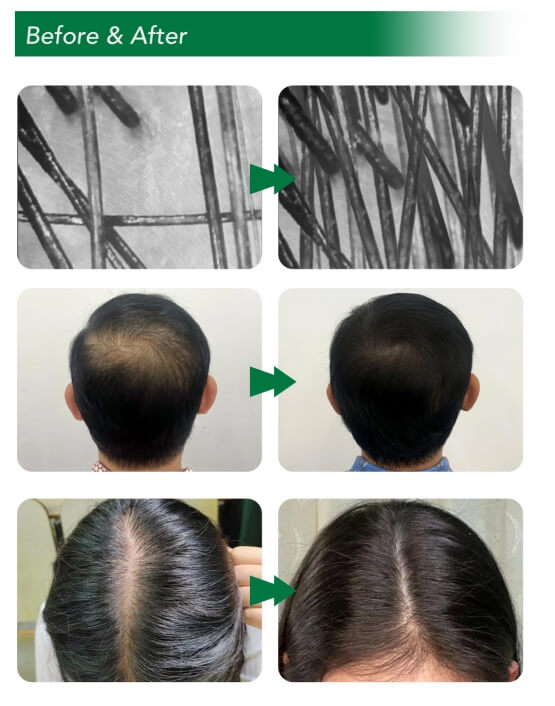 Real Exosome Therapy for Hair Loss Reviews