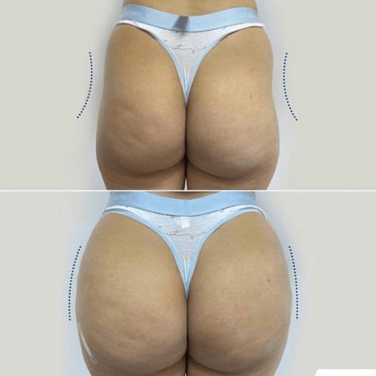 Devolux Plus plla buttock filler before and after