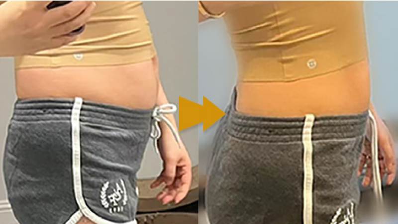 fat dissolving injections review before and after