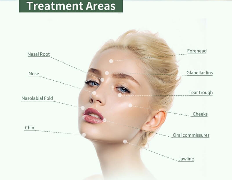 PrimeFill PMMA Injections treatment areas