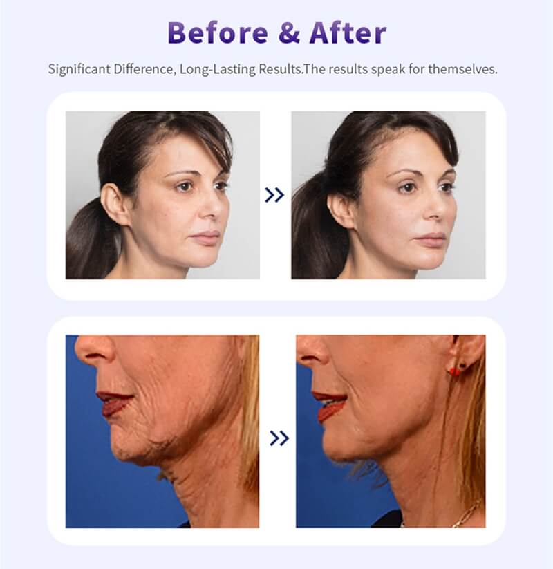 cheap cog thread pdo lifting before and after