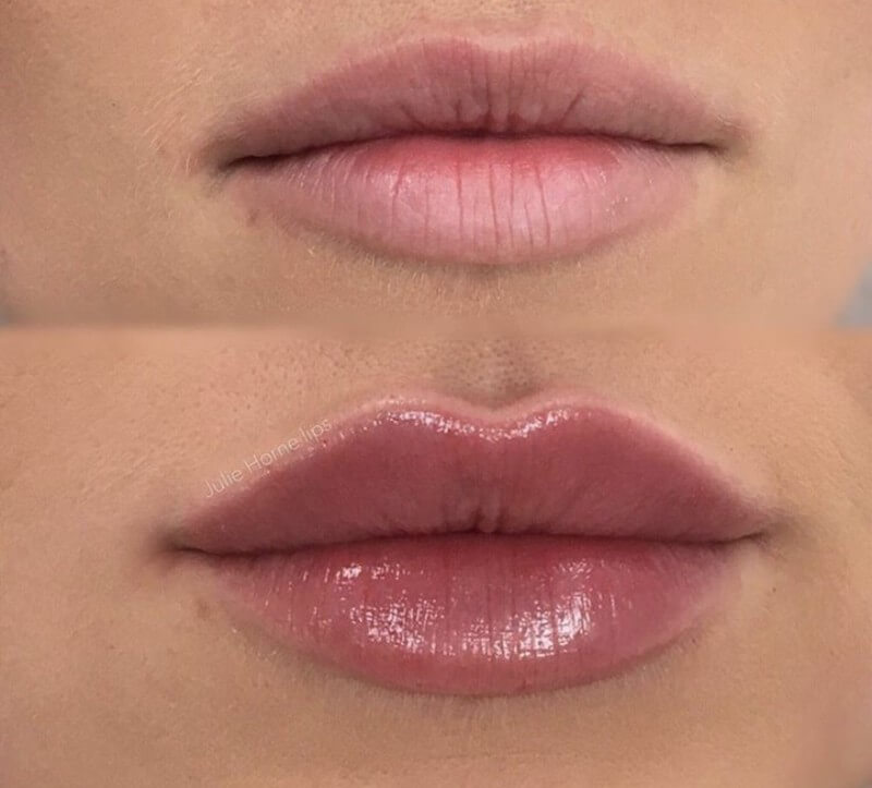 korean cherry lip filler