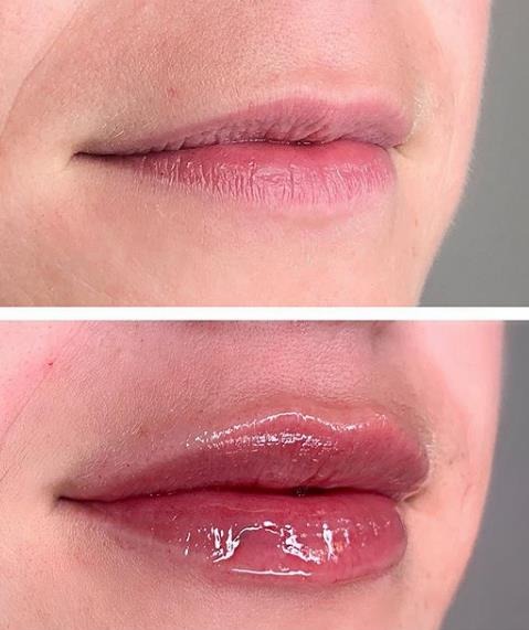 2ml lip filler before and after natural result