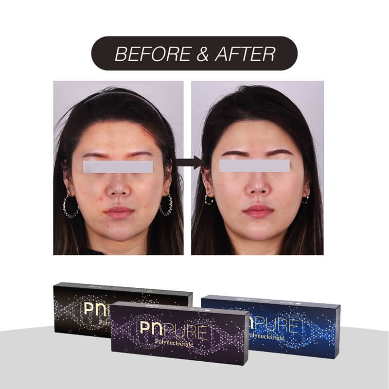 how long does it take for polynucleotides to work