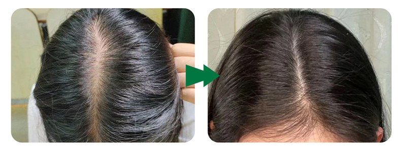 exosome hair therapy before and after