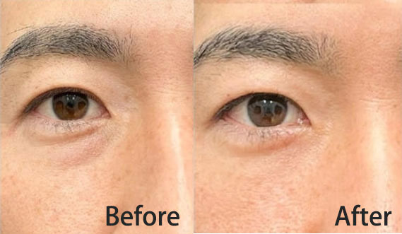 PNPURE&trade; Polynucleotide Filler before after