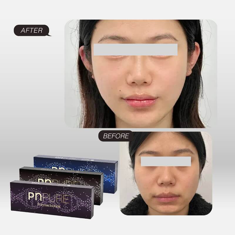 PNPure™ Polynucleotide Skin Boosters