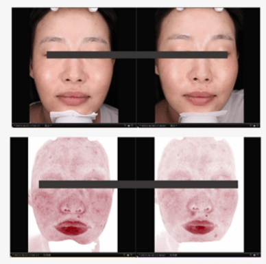 PDRN Treatment Before and After