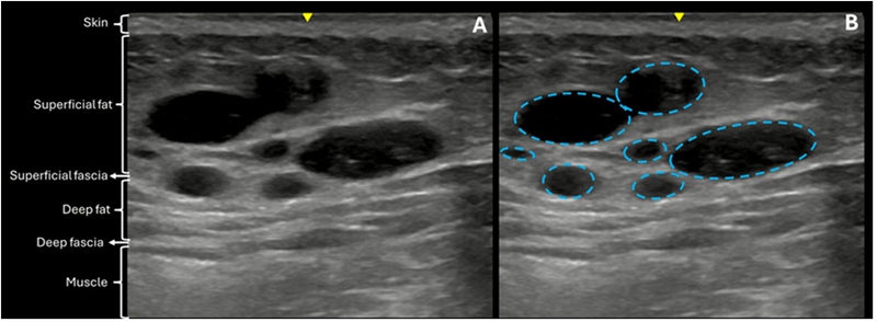 Buttock Augmentation With Hyaluronic Acid