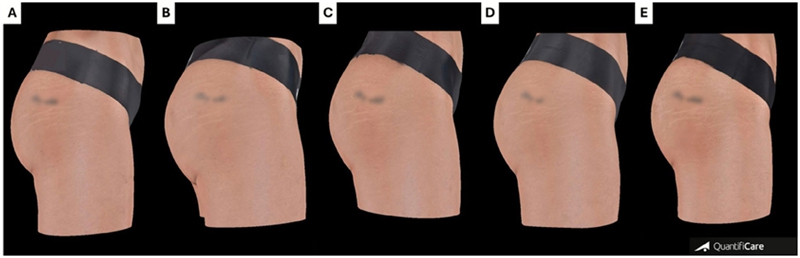 Buttock Augmentation With Hyaluronic Acid