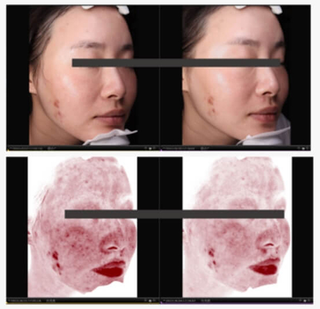mesocel salmon PDRN before after (2).jpg