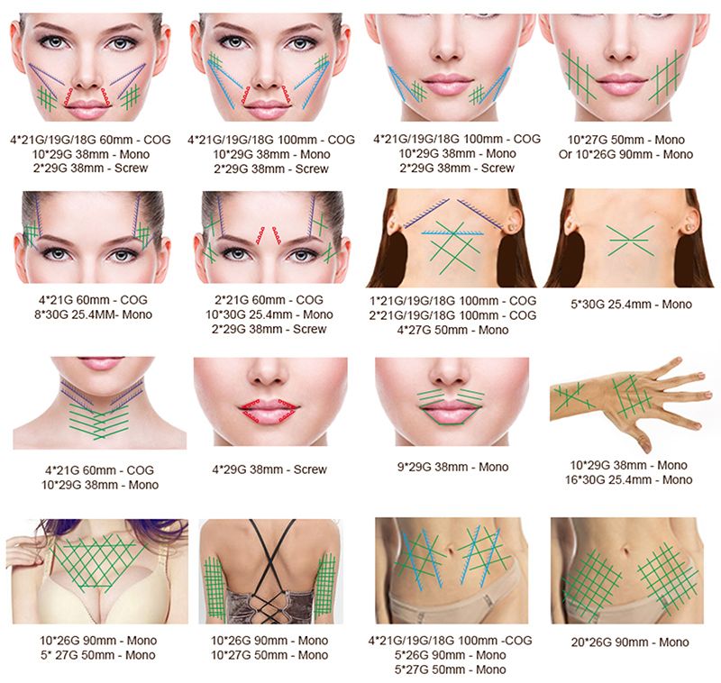 Application of pdo thread lift