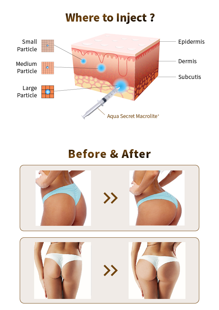 hyaluronic acid for buttock augmentation