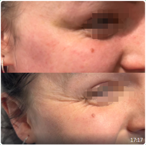 botulax before and after 3