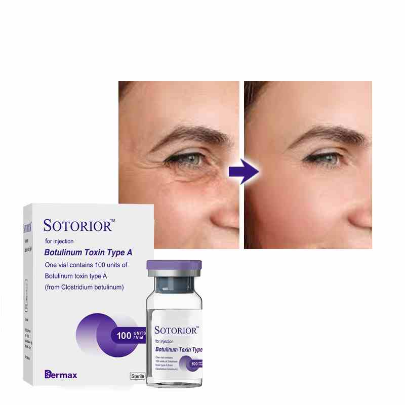 sotorior Botulinum Toxin Help With Crows Feet