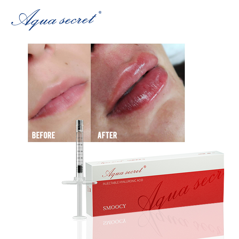 How Much Is a Lip Filler in Las Vegas? Cost, Providers & Tips