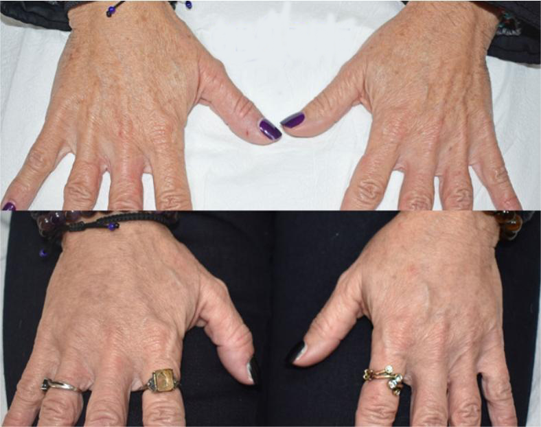 CHArmacy-CaHA-Filler-before-and-after-(2)(1)