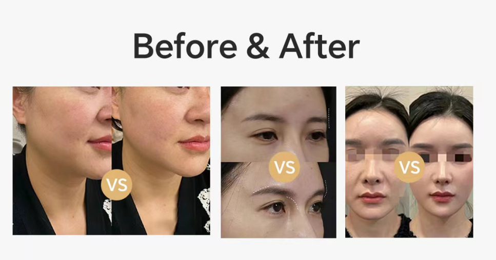 calcium hydroxylapatite dermal filler before and after