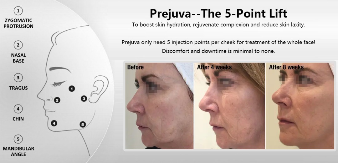 Prejuva five face lift point