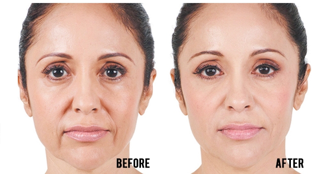 Before and After of CHArmacy CaHA Fillers