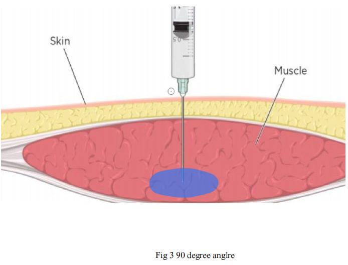 Macrolite Hyaluronic Acid Gel Injection Buttocks procedure 3