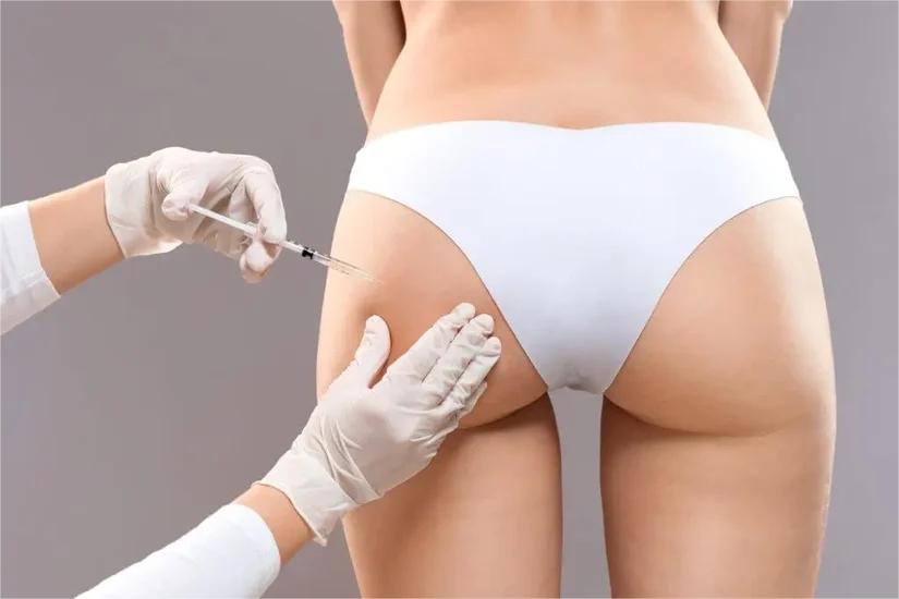 non-surgical butt filler injection