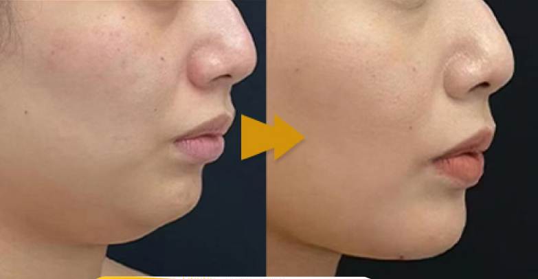 Double Chin Treatment Using Lipolab