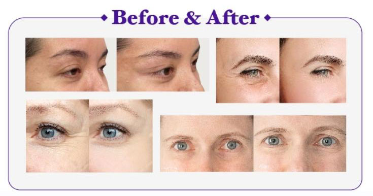 pdo smooth threads before and after