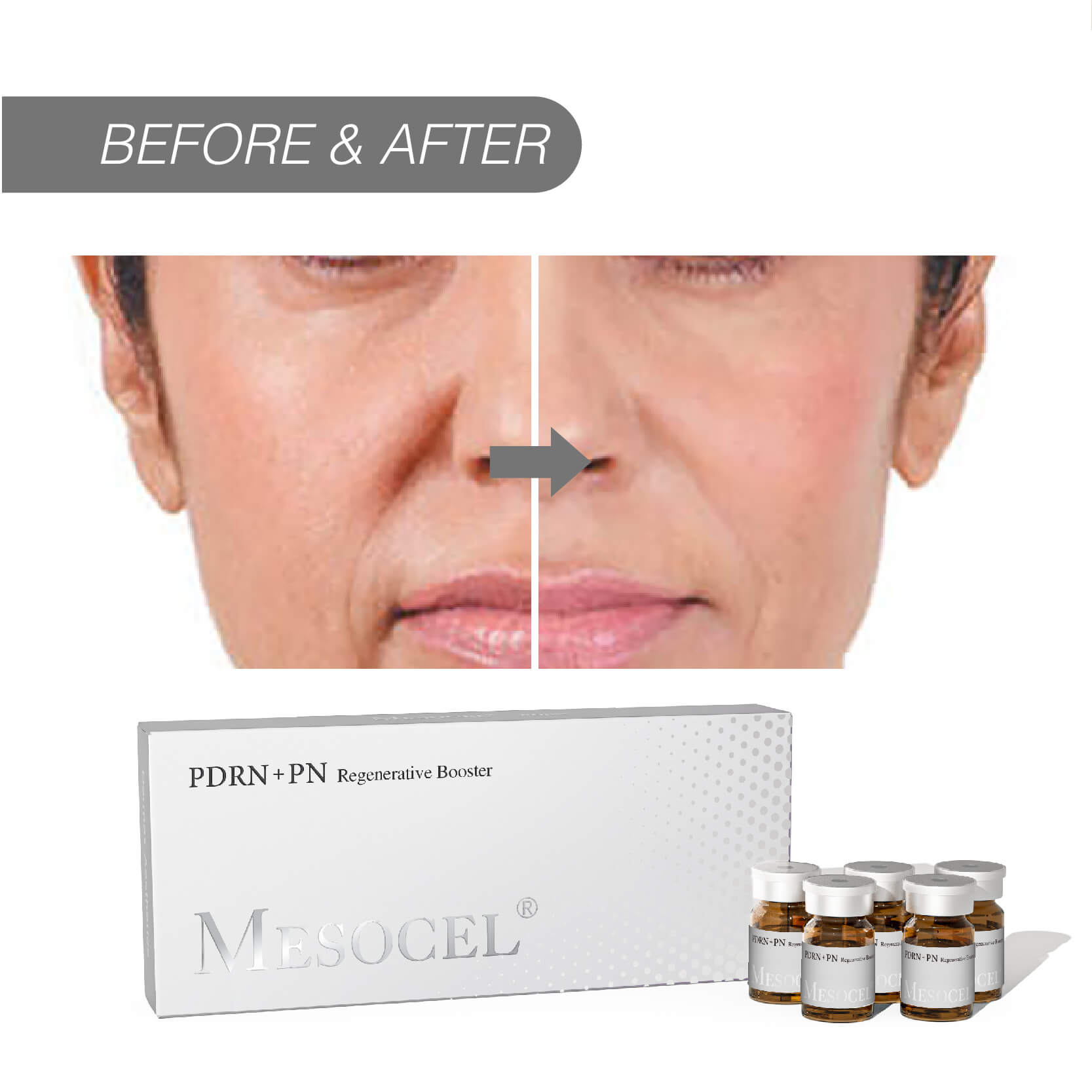 PDRN Mesotherapy vs Microneedling: Key Differences Explained