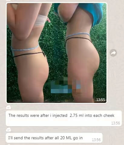 Macrolite Hyaluronic Acid Buttock Filler before and after (2)