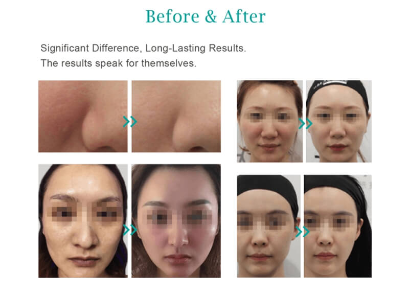 korean plla filler injections before and after photos