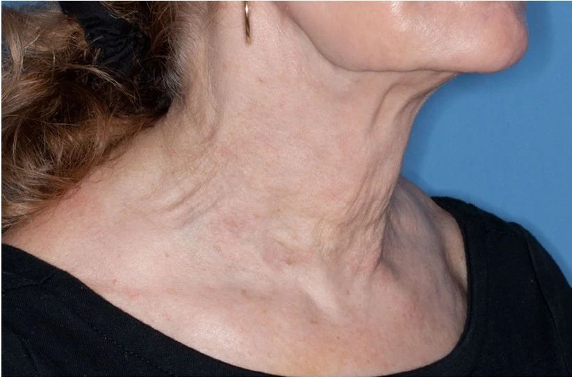 Nodule resolution after saline treatment