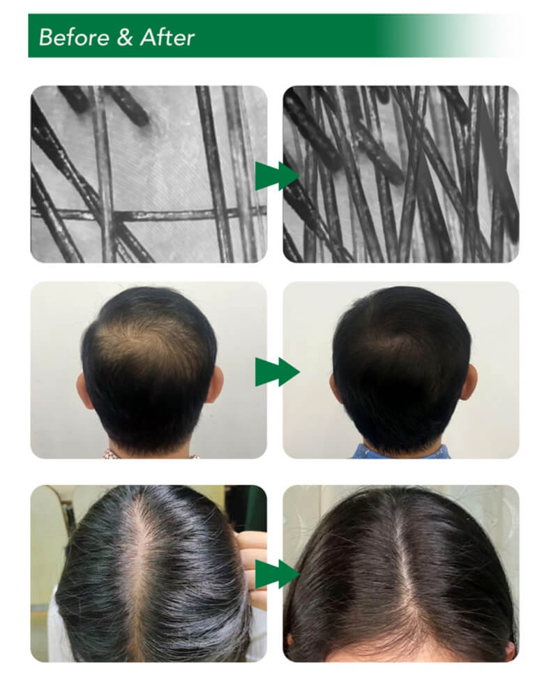 Exosomes for Hair Loss Before and After Results
