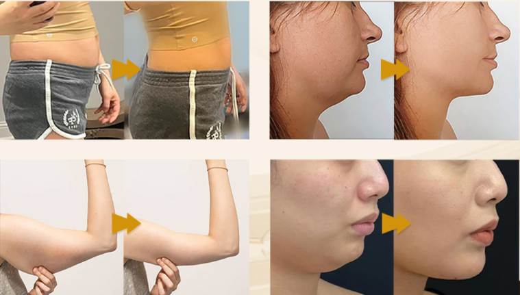 Non Surgical Fat Dissolving Injections Products before after