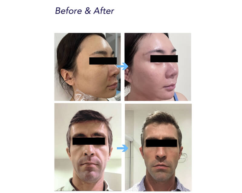 calcium hydroxyapatite dermal filler treatment areas