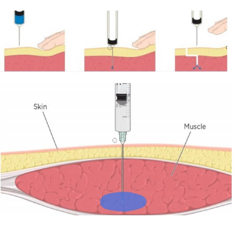 dermal filler for breast