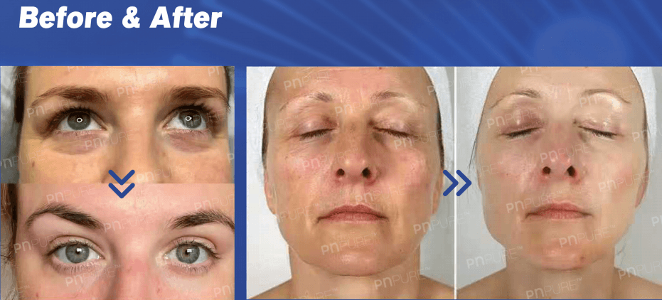 PN for face treatments 