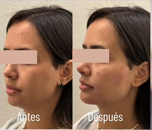 Revisage ha dermal filler before after